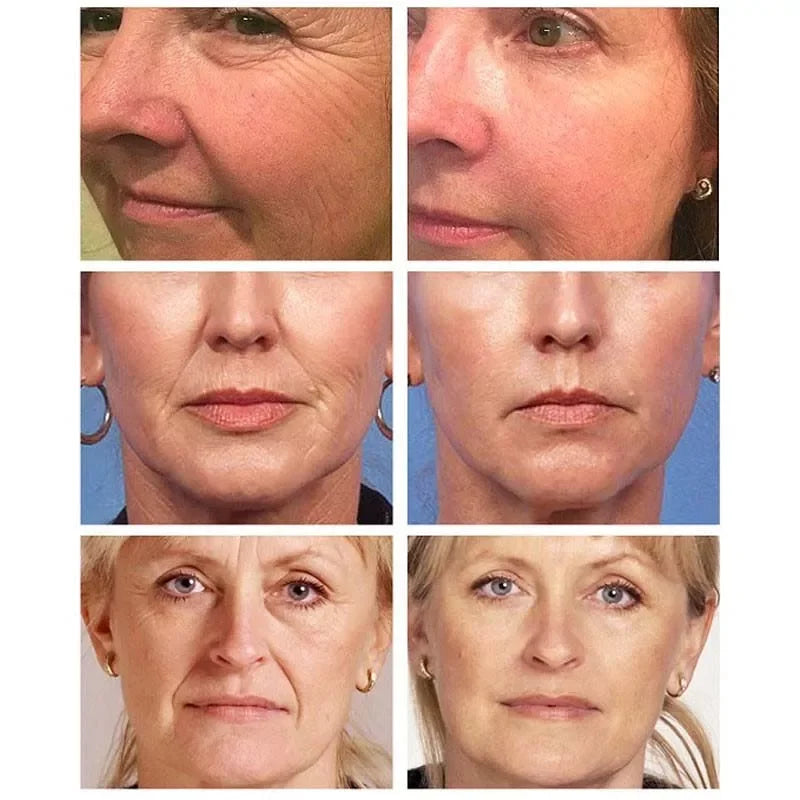 Instant Wrinkle Removal Serum